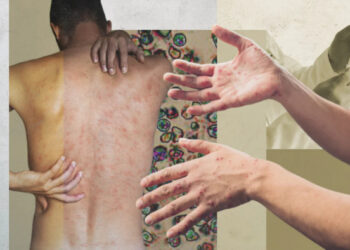 Епідемія вже близько? Все, що варто знати про кір