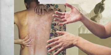 Епідемія вже близько? Все, що варто знати про кір