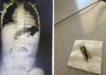 На Закарпатті 6-місячній дитині видалили заколку зі шлунка –