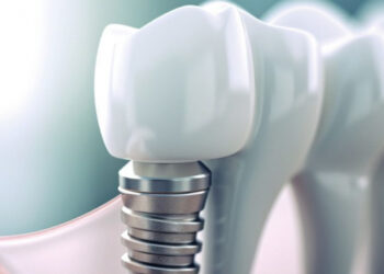 Стоматологічні інструменти для імплантології: що потрібно для успішної імплантації