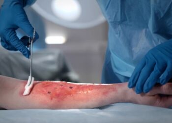 У Перечині юнак потрапив до лікарні з термічними опіками від спалаху пального