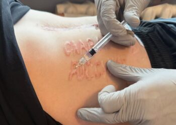 Лікар пояснив, хто і як зробив українському захиснику шрам “Слава России”