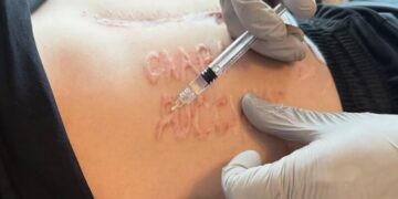 Лікар пояснив, хто і як зробив українському захиснику шрам “Слава России”