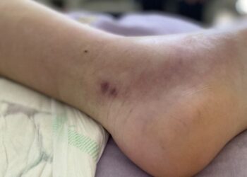 У МОЗ розповіли, скільки укусів змій зафіксовано на Закарпатті та в інших областях за 2 місяці — Закарпаття