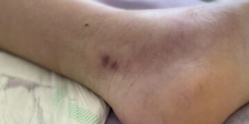 У МОЗ розповіли, скільки укусів змій зафіксовано на Закарпатті та в інших областях за 2 місяці — Закарпаття