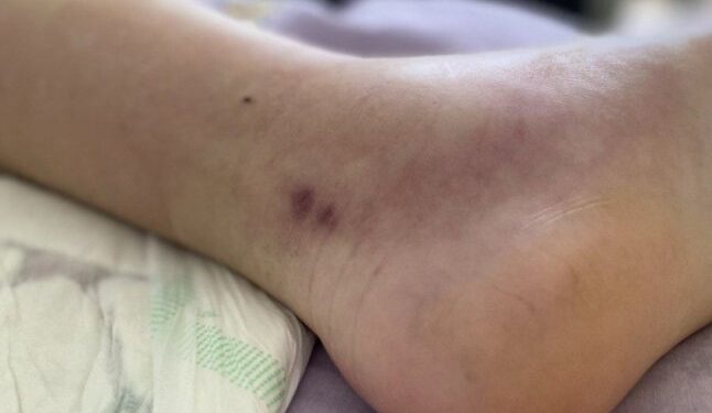 У МОЗ розповіли, скільки укусів змій зафіксовано на Закарпатті та в інших областях за 2 місяці — Закарпаття