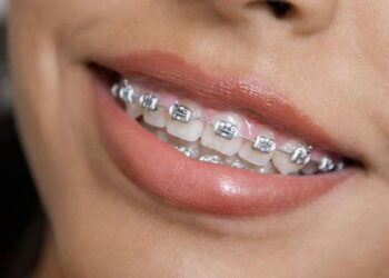 Металеві брекети: класичний вибір для виправлення прикусу