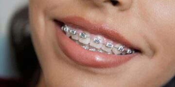 Металеві брекети: класичний вибір для виправлення прикусу