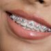 Металеві брекети: класичний вибір для виправлення прикусу