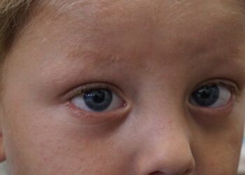 На Закарпатті лікарі врятували зір трирічному хлопчику, який заклеїв очі суперклеєм (ФОТО)