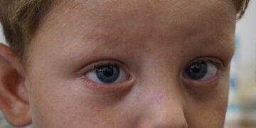 На Закарпатті лікарі врятували зір трирічному хлопчику, який заклеїв очі суперклеєм (ФОТО)