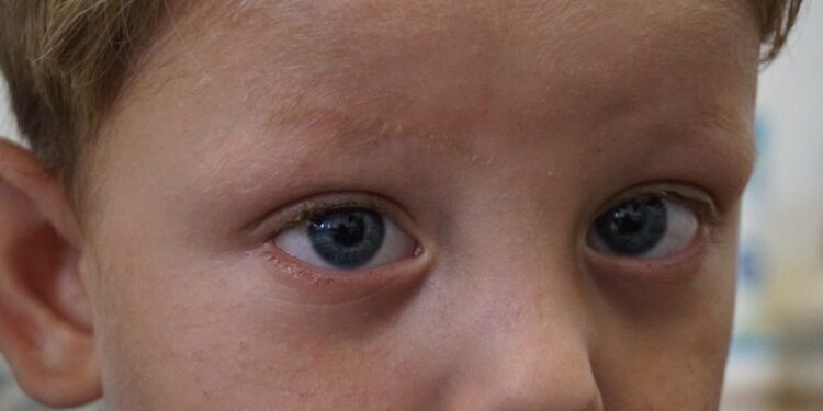 На Закарпатті лікарі врятували зір трирічному хлопчику, який заклеїв очі суперклеєм (ФОТО)