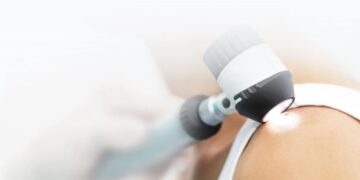 Видалення невусів лазером – особливості та переваги процедури