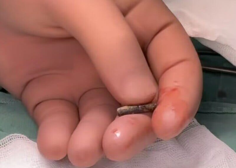 Український військовий три роки жив із кулею в серці. Що з ним сталося?